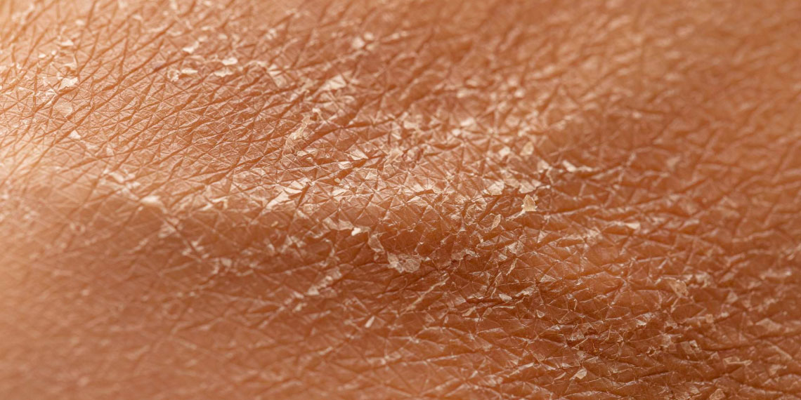 dehidrirana in suha koža zaradi pitja alkohola - pomembnost zadostnega vnašanja tekočin