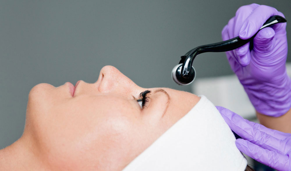 Storitev Microneedling