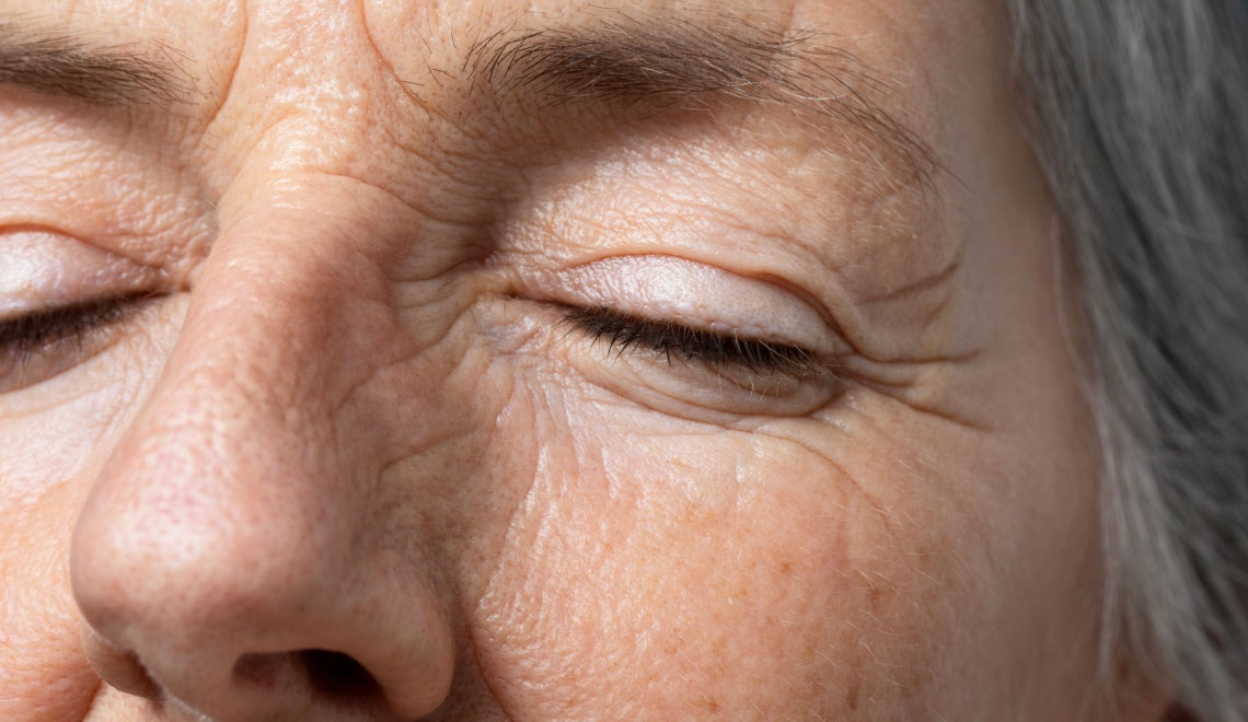 staranje kože zaradi alkohola - gube, linije, izguba tonusa